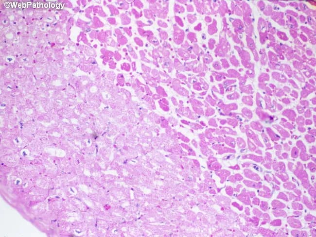 Imaging modality: Light microscopy of hematoxylin-eosin (H&E) stained cardiac tissue. Specimen is paraffin-embedded myocardial section, 5 micron thick, imaged with bright-field optics at high magnification. Anatomic region: left ventricular myocardium with an infarct in the left half of the field. The histology demonstrates pallor of necrotic cardiomyocytes (myocytolysis) produced by sarcolemmal disruption with influx of salt and water and cytoplasmic swelling. In this early post-ischemic stage, fibers lose cross-striations and display increased eosinophilia; nuclei are often absent or pyknotic. The infarct border may show waviness of fibers and mild edema; contraction bands may be present at the margin. Neutrophilic infiltration is typically minimal during the first 24 hours but may begin to appear around this window. The combination of coagulative necrosis, myocytolysis, and pallor indicates an acute myocardial infarction approximately one day old. This histologic pattern correlates with ischemia from coronary occlusion, clinical presentation of acute coronary syndrome, and aligns with diagnostic timelines (0-24 h). Clinically the image supports timing of infarct and helps distinguish acute infarction from myocarditis or chronic scar, serving as an educational reference for pathology, medical education, and research on myocardial injury dynamics. Further confirmed by clinical correlation and education.