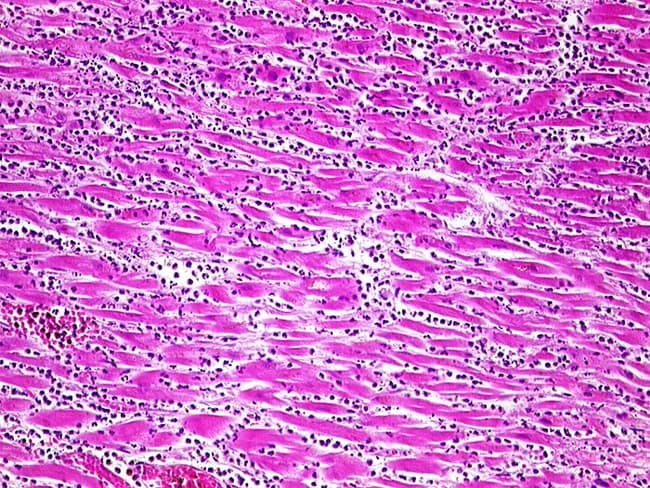 Imaging modality: Light microscopy of Hematoxylin and Eosin stained myocardial tissue from the left ventricle. This histopathology slide shows acute myocardial infarction with a pronounced inflammatory response at approximately 3-4 days age. Necrotic cardiomyocytes appear with eosinophilic, homogeneous cytoplasm and loss of nuclei, set within a pink, edematous interstitium. Surrounding the necrotic fibers is a dense neutrophilic infiltrate; small dark neutrophils with segmented nuclei are dispersed between intact fibers and around necrotic zones. Early macrophage recruitment may be evident at the infarct border as inflammation persists. Overall architecture shows patchy zones of myocyte loss, with preserved but stressed neighboring myocardium. No organized scar or fibrosis is yet apparent. The staining highlights cellular morphology and tissue organization: striated muscle fibers, cross-striations partially disrupted, and interstitial edema. Clinically, this constellation supports an infarct age of several days, with active inflammation and a high risk of mechanical complications if the infarct is transmural. The image is relevant to teaching, diagnostic pathology, and research on post-infarct healing, inflammation, and ballooning necrosis; it also aids correlation with electrocardiographic changes and serum biomarkers (troponin, CK-MB). This micrograph exemplifies stage-specific histology of myocardial infarction and underscores the importance of timing in diagnosis, prognosis, and therapy planning strategies.