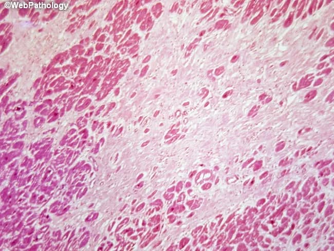 Histopathology of cardiac tissue displaying a healed myocardial infarction with dense collagenous scar replacing necrotic myocardium. Hematoxylin and eosin (H&E) stained section reveals extensive fibrous scar interposed between islands of residual viable myocytes, with loss of normal myofiber architecture and diminished cross‑striations. The scar tissue appears eosinophilic and tightly organized, forming collagen bundles that disrupt parenchymal continuity. In this chronic stage, inflammatory cells are minimal or absent, and granulation tissue is not prominent, consistent with scar maturation. The histologic pattern reflects replacement-type fibrosis and perpetual remodeling of the left ventricular wall; the infarct age is difficult to ascertain from morphology once the scar has matured, as features of early healing (neutrophilic infiltrates, macrophage activity, neovascularization) have resolved. Clinical relevance centers on remote myocardial injury, reduced compliance, potential regional wall motion abnormalities, and arrhythmogenic substrate. The specimen demonstrates a structural basis for prior ischemic insult, guiding clinical correlation with patient history of chest pain or elevated cardiac enzymes. This image is valuable for educational purposes in cardiopathology, illustrating differentiation of healed infarct from ongoing ischemia, active myocarditis, or nonspecific fibrous scar, and highlighting the diagnostic significance of replacement fibrosis in coronary artery disease. Correlate clinically for prognosis and therapeutic planning assessment.