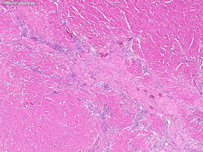Histopathology with Hematoxylin and Eosin staining of cardiac myocardium. Low-power (4x–10x) view highlights ongoing inflammatory infiltrate within the myocardial interstitium and surrounding fibrous remodeling in the central portion of the field. In acute lymphocytic myocarditis, infiltrates are predominantly lymphocytes with accompanying macrophages, plasma cells, and occasional eosinophils in eosinophilic (hypersensitivity) variants. The myocardium shows non-ischemic myocyte destruction and interstitial fibrosis, consistent with Dallas criteria for myocarditis. The subepicardial and mid-wall distribution of inflammation and necrosis supports a non-coronary etiology, distinguishing from ischemic injury which concentrates within the subendocardium. Immunophenotyping may reveal a predominance of T-lymphocytes (CD3+) and, in hypersensitivity cases, marked eosinophilic involvement. Pathologic diagnosis of myocarditis carries prognostic significance, with potential progression to dilated cardiomyopathy or heart failure if inflammation persists. Clinically, findings may correlate with chest pain, troponin elevation, arrhythmias, and systolic dysfunction. Differential diagnoses include viral myocarditis, eosinophilic myocarditis, giant cell myocarditis, and ischemic cardiomyopathy. This image is relevant for education on histologic patterns of inflammatory heart disease, diagnostic pathology workflows, and research into inflammatory cardiomyopathies, immune-mediated injury, and treatment responses. It also serves as a reference for grading active inflammation versus chronic fibrotic scarring in myocardial tissue.