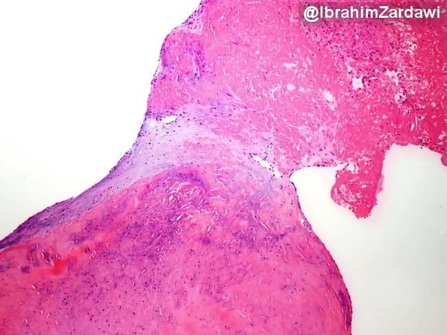 Infective endocarditis histology image demonstrating a valve leaflet vegetation attached to the endocardial surface. The lesion is a friable thrombus-rich mass composed predominantly of fibrin and platelets with an inflammatory cell infiltrate. Bacterial colonies are not evident on routine hematoxylin and eosin staining, which can occur in culture-negative endocarditis or after prior antibiotic exposure; additional stains or culture may reveal organisms. The vegetation is anchored to the valve leaflet, illustrating the pathological substrate of infection and its interface with native tissue. This pattern supports a diagnosis of infective endocarditis in the clinical context and helps distinguish from noninfectious vegetations such as marantic endocarditis or Libman-Sacks endocarditis. Clinically, the histology guides antimicrobial strategy, duration, and need for surgical evaluation, given the embolic potential of friable vegetations. Educationally, this image is valuable for cardiac pathology and infectious disease training, highlighting thrombus-dominated composition, inflammatory infiltration, and the frequent absence of visible bacteria on standard histology.