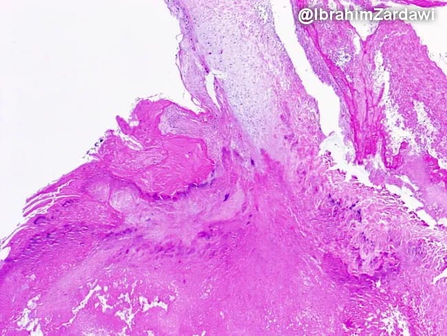 Histology of a cardiac valve vegetation from an intravenous drug user with infective endocarditis. The specimen was processed for light microscopy and stained with hematoxylin and eosin (H&E). The vegetative mass adheres to the valvular surface and shows a dominant thrombus composed of densely packed fibrin and platelets, with admixed bacterial colonies appearing as dark purple clusters within the eosinophilic matrix. The core is friable and irregular, with a leafy, chain-like fringe along the valve edge. The bacterial colonies are variably distributed, forming focal microcolonies that disrupt surrounding tissue architecture. There is limited or variable inflammatory cell infiltrate; neutrophils may be present at the margins, consistent with acute infective endocarditis. The overall pattern is consistent with septic endocarditis in an intravenous drug user, where bacteria colonize a pre-existing thrombus on the valve surface, producing vegetations that may embolize. Clinically, histology complements microbiology and imaging to confirm diagnosis and guide antibiotic therapy. Diagnostic significance includes identification of infectious vegetations on valves, distinguishing from sterile thrombi, and informing prognosis. Potential differential diagnoses include nonbacterial thrombotic endocarditis and Libman-Sacks endocarditis in alternative clinical settings. This image is valuable for education on endocarditis pathology, valve destruction, and the histopathology of septic vegetations.