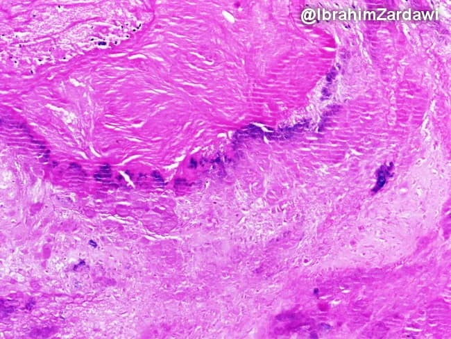This slide is a histopathology image prepared from a cardiac valve vegetation in an intravenous drug user with infective endocarditis. The imaging modality is light microscopy of a formalin-fixed tissue section, stained with Hematoxylin and Eosin (H&E). The specimen type is a valvular vegetation consisting predominantly of a layered thrombus adherent to the valve surface, with bacterial colonies embedded within the fibrinous matrix. Under bright-field illumination, the thrombotic core appears pink to eosinophilic, while bacterial colonies stain dark purple to basophilic, forming discrete foci along the advancing edge of the vegetation. The surrounding tissue shows minimal to moderate inflammatory response, with neutrophils scattered at the periphery and scant residual myocardium at risk of ischemia. Overall architecture demonstrates an avascular, friable mass of fibrin, platelets, and microorganisms extending from the valvular surface into the endocardium. This histopathologic pattern supports a diagnosis of infective endocarditis, with organisms typical of IV drug users often Staphylococcus aureus or streptococcal species. The diagnostic significance lies in confirming infection of the endocardial surface and in guiding antimicrobial therapy, risk stratification, and surgical planning. Clinically, correlate with fever, positive blood cultures, echocardiography findings, and valve dysfunction. High-quality images enable teaching, reference, and research on endocarditis pathophysiology principles.