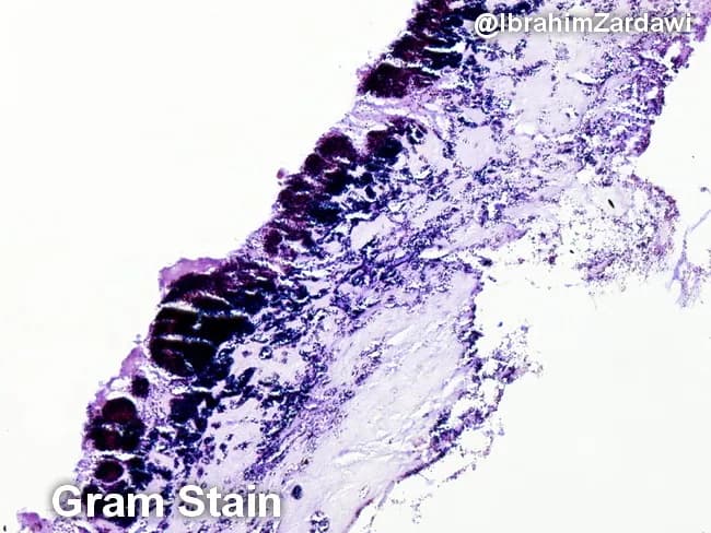 This histology image is a light-micrograph of a Gram-stained valvular vegetation from a case of infective endocarditis. The specimen is cardiac valvular tissue; the vegetation comprises a fibrin-rich, platelet-laden thrombus with embedded bacterial colonies along the endocardial surface. Gram staining highlights Gram-positive cocci as purple to deep purple clusters within the thrombus, indicating organisms such as Streptococcus spp., Staphylococcus spp., or Enterococcus. The bacterial colonies are adherent to the valvar surface within a dense inflammatory milieu, with neutrophilic infiltrate and tissue necrosis limited to microdomains. The histologic architecture demonstrates vegetations typical of endocarditis: a friable, topographically irregular lesion on the valve with microabscess-like foci and bacterial encasement within fibrin. The presence of Gram-positive bacteria on histology supports a bacterial endocarditis diagnosis and guides antimicrobial therapy pending culture confirmation. Clinically, such histologic confirmation is critical for distinguishing infectious from non-infectious valve pathology, for clarifying the etiologic category of pathogens (oral flora-related viridans Streptococcus, Staphylococcus aureus, enterococci), and for correlating with blood culture, echocardiographic findings, and patient risk factors. This image is valuable for educational purposes, illustrating Gram stain morphology in endocardial vegetations and reinforcing the need for targeted antibiotics and possible surgical consultation.