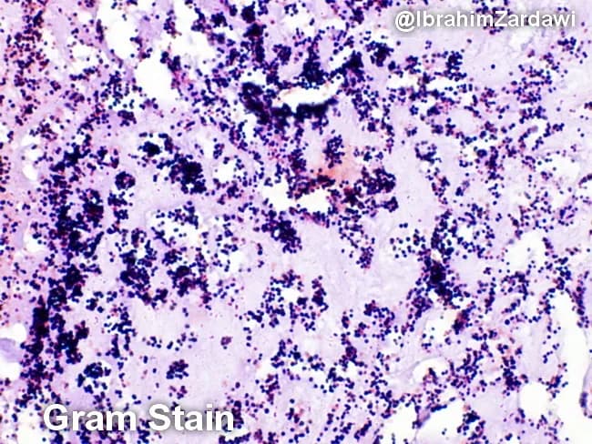 Imaging modality: Light microscopy; Gram staining of a histologic section of a cardiac valve vegetation from suspected infective endocarditis. The specimen shows a dense, friable vegetative mass within valve tissue characterized by a fibrinous, platelet-rich matrix in which numerous Gram-positive cocci are adherent. On the Gram stain, the cocci appear as purple spherical cells arranged in clusters and sometimes in short chains, consistent with Gram-positive organisms. The background demonstrates inflammatory cells and debris typical of endocardial infection. The histologic architecture indicates vegetative lesions with microbial colonization and a biofilm component. These findings correlate with infective endocarditis due to cocci such as Staphylococcus aureus or viridans-group streptococci in clinical practice, though Gram stain alone cannot specify species. The image is a micrograph provided with permission by Dr. Ibrahim Zardawi; image shows classic histopathology of bacterial endocarditis. The diagnostic significance lies in confirming bacterial endocarditis and guiding immediate management including empiric antibiotic therapy targeting Gram-positive cocci while awaiting culture results. This image is valuable for pathology education, microbiology correlation, and endocarditis research. Potential clinical use cases include training in Gram stain interpretation, distinguishing bacterial endocarditis from sterile vegetations, and supporting diagnosis when blood cultures are pending.