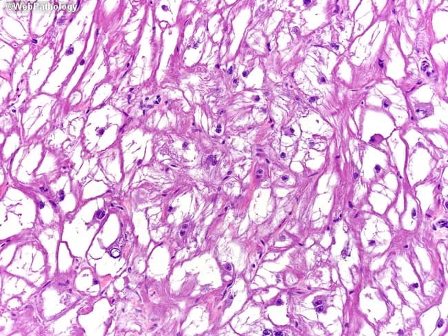 Light microscopy histology image of ventricular myocardial tissue stained with Periodic Acid-Schiff (PAS) highlighting glycogen-rich, vacuolated cardiac myocytes with spider cell morphology. Centrally placed nuclei with radiating, slender myofibrils produce the characteristic spider-like appearance and a distinctive periphery of cytoplasmic processes. PAS stain yields strong magenta coloration because of abundant glycogen, while conventional hematoxylin provides nuclear contrast. Electron microscopy described in the referenced material shows abundant glycogen, few irregular myofibrils, and poorly developed sarcoplasmic reticulum, supporting a benign, hamartomatous rhabdomyoma rather than a malignant sarcoma. Morphologically, tumor cells are large, polygonal, with clear cytoplasm and delicate, sparse myofilaments; cell borders may appear interwoven within the myocardium, reflecting a proliferative but well-differentiated muscular lineage. This constellation—spider cells, glycogen-rich cytoplasm, central nuclei, radiating myofibrils—constitutes a classic histopathologic signature for cardiac rhabdomyoma, especially in pediatric patients and in the context of tuberous sclerosis complex. Clinically, the presence of such tumors can yield arrhythmias or obstruction depending on size and location; prognosis is often favorable with potential spontaneous regression. Diagnostic relevance excludes most malignant cardiac neoplasms; differential diagnoses include rhabdomyosarcoma and myxoma, but immunophenotype and ultrastructure typically resolve the diagnosis. Correlation with clinical imaging and genetics further strengthens the definitive assessment in pediatric care.