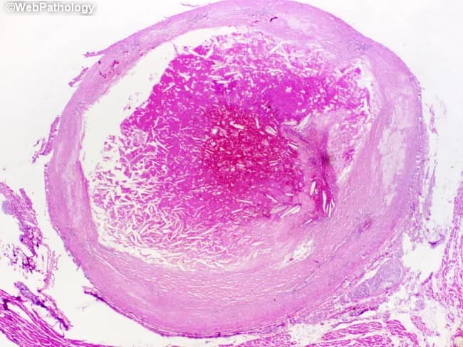 Imaging modality: Histopathology - light microscopy of an intact coronary arterial cross-section, stained with H&E. Specimen location: Left anterior descending coronary artery (LAD), proximal to mid-segment, from an adult male with known ischemic heart disease who died suddenly. Observed features: atherosclerotic plaque rupture with overlying luminal thrombosis; the lumen is nearly occluded over a 1.0 cm segment. The plaque shows a lipid-rich necrotic core and a thin, disrupted fibrous cap; the intima is thickened with yellowish plaque. The thrombus is adherent to the plaque rupture site and extends into the lumen, composed of platelets, fibrin, erythrocytes; the arterial wall demonstrates media degeneration and intimal atherosclerosis. The overall morphology is consistent with acute coronary thrombosis leading to myocardial ischemia and sudden death; histology may reveal early myocardial changes if present elsewhere. Diagnostic significance: this pattern explains sudden cardiac death due to acute myocardial infarction from an occlusive coronary thrombus following plaque rupture; differential considerations include spontaneous coronary dissection, vasospastic occlusion, or embolic events; clinical correlation with ischemic heart disease history supports the infarction mechanism. This image is valuable for education on pathophysiology of plaque rupture, thrombus formation, and fatal acute coronary syndrome; relevant to cardiology, pathology, and medical education.