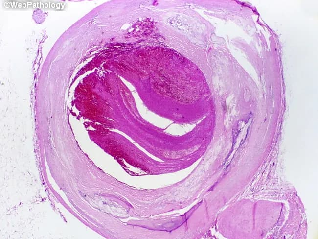 This is a light microscopic histopathology image of a human left anterior descending (LAD) coronary artery segment from autopsy. The specimen shows an atherosclerotic plaque with rupture of the fibrous cap and overlying luminal thrombosis, resulting in near-complete occlusion of the arterial lumen over approximately 1.0 cm. The arterial wall reveals intimal thickening with a lipid-rich necrotic core, cholesterol clefts, and inflammatory cells. The ruptured plaque exposes subendothelial thrombogenic material, provoking platelet aggregation and formation of an occlusive red thrombus that markedly narrows the lumen. The thrombus appears organized with layered eosinophilic material and fibrin, consistent with thrombotic components seen in acute coronary syndromes. The surrounding media may show early degenerative changes typical of atherosclerosis. This lesion corresponds to a fatal acute myocardial infarction in a patient with a history of ischemic heart disease and prior CAD. Clinically, the finding supports sudden cardiac death due to acute coronary occlusion from plaque rupture. The image emphasizes the pathophysiology of myocardial infarction: plaque instability, thrombosis, rapid flow limitation, and myocardial ischemia. It provides a classic autopsy correlate for education, teaching, and research on coronary atherosclerosis, plaque rupture, thrombosis, and sudden death. This histology image is ideal for autopsy teaching and cardiac pathology research.