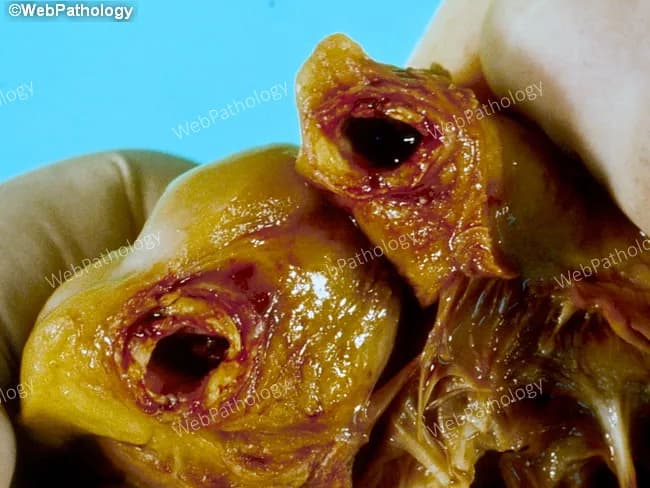 Gross pathology photograph from an autopsy showing the heart with acute coronary occlusion. Anatomical site: right coronary artery (RCA) with heavy atherosclerotic disease and a mural thrombus occluding the lumen. Plaque morphology is lipid-rich, irregular, and yellow-brown with possible calcification. The overlying thrombus is dark reddish-brown, adherent to the plaque, and partially fills the arterial lumen, producing abrupt cessation of distal flow. Associated myocardial tissue may show early signs of infarction, such as pallor or edema in the distribution supplied by the RCA. Imaging modality and technique: macroscopic gross pathology image, en-face view of the epicardial artery from autopsy; not a radiologic study and not stained. Pathophysiology: sudden plaque rupture with superimposed mural thrombosis causing acute myocardial infarction (AMI) and death within 72 hours. Clinical correlation: this lesion represents a classic mechanism of fatal coronary artery disease, leading to hemodynamic compromise and ventricular dysfunction. Diagnostic significance: demonstrates the chain of events from atherosclerotic plaque disruption to occlusive thrombosis and myocardial necrosis, illustrating the basis for sudden cardiac death in CAD. Differential considerations include plaque rupture with thrombosis, coronary vasospasm, embolic occlusion, and multivessel atherosclerosis. Educational value: aids understanding of MI pathogenesis, coronary thrombosis, and autopsy-based cardiovascular pathology.