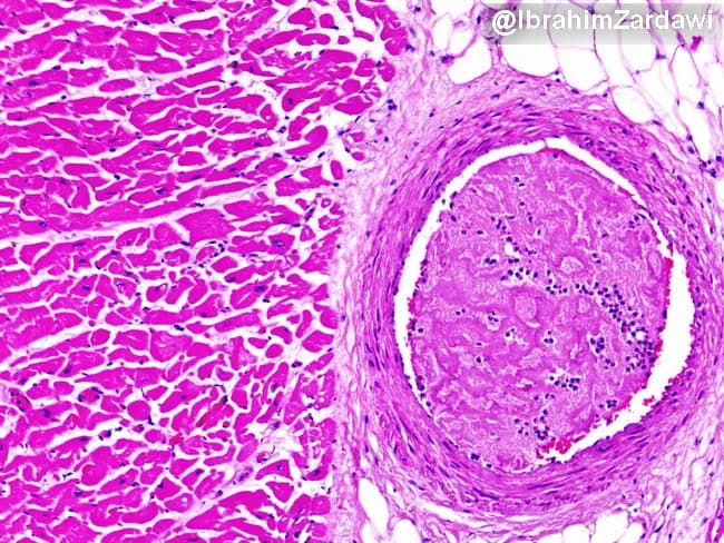 Imaging modality: Light microscopy of a hematoxylin and eosin (H&E) stained cardiac tissue section. Specimen type: paraffin-embedded myocardium with an intraluminal thrombus within a branch of a coronary artery. Imaging perspective: transverse cross-section illustrating occlusion of a coronary artery lumen by a recent thrombus and adjacent myocardial fibers. Major finding: occlusive thrombus densely eosinophilic within the arterial lumen, partially projecting into the vessel lumen and compressing flow. Vessel wall shows no striking dissection; subtle intimal thickening may reflect underlying atherosclerosis. Surrounding myocardium demonstrates preserved architectural integrity at this field of view, with no conspicuous extensive coagulative necrosis or inflammatory infiltrate evident at this early stage. The thrombus composition is suggested by a dense eosinophilic core with fibrous and platelet-rich components, typical of acute thrombosis; perivascular tissue shows mild edema. Clinical interpretation: acute coronary syndrome due to acute thrombotic occlusion of a coronary branch, likely on a preexisting atherosclerotic plaque. Diagnostic significance: provides histopathologic confirmation of thrombosis as the mechanism of ischemia; differential considerations include embolic occlusion, vasospasm with secondary thrombosis, or plaque rupture; correlate with clinical presentation and angiography. Potential educational uses: pathophysiology of myocardial ischemia, ACS, coronary thrombosis, histology of coronary arteries, and teaching images of acute myocardial infarction pathology.