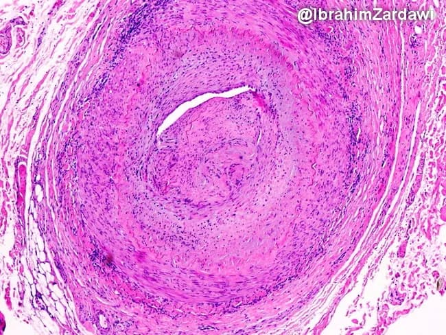 Histology image obtained from a temporal artery biopsy, prepared with Hematoxylin and Eosin stain and viewed under light microscopy at low magnification. The specimen demonstrates classic giant cell arteritis with transmural, granulomatous inflammation encompassing the full thickness of the arterial wall (intima, media, and adventitia) in a segmental distribution. Multinucleated giant cells are interspersed with a dense lymphohistiocytic infiltrate, and fragmentation or disruption of the internal elastic lamina is evident. The inflammatory process extends to the vasa vasorum and small venules within the adventitia, indicating widespread perivascular involvement. Accompanying features include marked intimal hyperplasia producing marked luminal narrowing and, in this field of view, near-occlusive lumen occlusion. The arterial media may show loss of elastic fibers and necrosis is not conspicuous here. These findings are diagnostic of GCA and help differentiate from other large-vessel vasculitides and nonspecific atherosclerotic changes. Clinically, such histology supports a diagnosis of temporal arteritis in patients with new headaches, visual symptoms, jaw claudication, and elevated inflammatory markers, guiding urgent corticosteroid therapy to prevent ischemic complications. This image exemplifies the radiologic-pathologic correlation typical of vasculitic arteritis. The slide highlights diagnostic relevance, research utility, and educational value for trainees and clinicians in practice. For medical education and research.