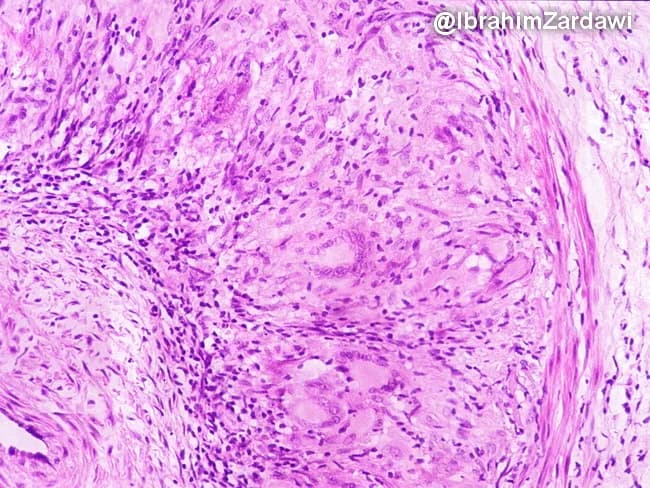 Imaging modality and technique: Brightfield light microscopy of a temporal artery biopsy stained with Hematoxylin and Eosin (H&E). Specimen: arterial wall from the temporal region; cross-sectional vascular biopsy showing inflammatory arteritis. Key features include granulomatous inflammatory infiltrate surrounding the media and adjacent to the internal elastic lamina, composed of lymphocytes, plasma cells, epithelioid histiocytes, and multinucleated giant cells. Giant cells are often present but may be absent; their presence supports diagnosis but is not required. The inflammatory infiltrate disrupts the media and may extend into the adventitia; fragmentation and phagocytosis of the internal elastic lamina are characteristic. Medial necrosis is minimal to absent; there is usually no well-formed granuloma or extensive necrosis. Neointimal hyperplasia and luminal narrowing can be observed as secondary consequences of chronic vasculitis. The image demonstrates a granulomatous arteritis pattern typical of giant cell arteritis. Diagnostic significance: classic histopathology includes granulomatous inflammation of medium-sized arteries with IEL fragmentation; biopsy positivity confirms temporal arteritis; however, skip lesions can yield false negatives; clinical correlation with headache, scalp tenderness, jaw claudication, visual symptoms and elevated inflammatory markers (CRP/ESR) is essential. Differential considerations include Takayasu arteritis, atherosclerosis, infectious vasculitis, and other granulomatous vasculitides. This slide is used in educational settings to illustrate GCA pathology and IEL involvement.