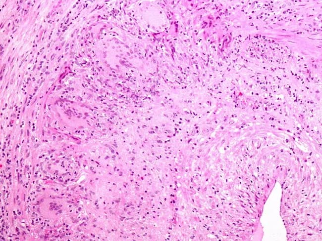 Imaging modality: Light microscopy of a temporal artery biopsy stained with Hematoxylin and Eosin. Precise anatomical localization: cranial temporal artery wall (temporal artery) with transmural involvement of the tunica intima and media. Visual features include a transmural lymphohistiocytic infiltrate with granulomatous inflammation and multinucleated giant cells; the internal elastic lamina is often disrupted with elastin debris that may be phagocytized. The architecture may be segmental, reflecting skip lesions; biopsy sensitivity can be limited, with a proportion of clinically suspected cases yielding negative results. Serial sectioning and submission of the entire specimen increase diagnostic yield. Clinical relevance centers on giant cell arteritis (temporal arteritis) in elderly patients presenting with new headaches and risk of irreversible vision loss if untreated. Differential considerations include Takayasu arteritis and polyarteritis nodosa. This histology image exemplifies canonical features: granulomatous vasculitis, giant cells, IEL disruption, and elastin fragmentation near the wall, reinforcing the importance of correlating histology with clinical syndrome and treatment urgency.
