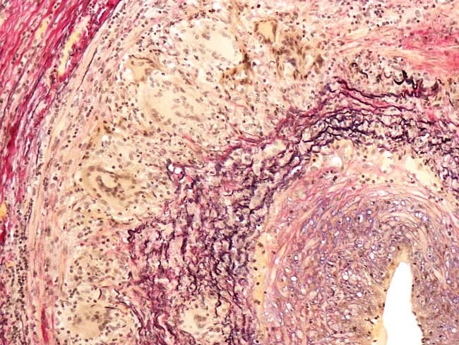 This histopathology image shows a temporal artery biopsy stained with an elastic stain (e.g., Verhoeff-Van Gieson) to highlight elastic laminae within the arterial wall. The specimen demonstrates classic giant cell arteritis features: fragmentation and partial duplication of the internal elastic lamina with loss of elastic fibers, and prominent intimal hyperplasia producing marked luminal narrowing. Inflammatory infiltrates, including mononuclear cells and multinucleated giant cells, surround the media in a granulomatous vasculitis pattern. Elastic lamina disruptions create irregular vascular borders and eccentric thickening of the intima. Some sections reveal medial edema and preserved outer adventitia, without definite necrosis. The overall morphology supports inflammatory arteritis affecting cranial arteries, particularly the superficial temporal artery. Clinically this histology aligns with temporal headache, jaw claudication, decreased vision risk, and elevated ESR/CRP in patients over 50. The diagnostic significance is high when elastic lamina fragmentation is present with compatible clinical symptoms. Differential considerations include atherosclerotic changes with intimal thickening and luminal narrowing, other large-vessel vasculitides such as Takayasu arteritis in younger patients, and other granulomatous diseases. Correlation with serology, imaging, and clinical presentation is essential for accurate diagnosis and timely glucocorticoid therapy. This image supports education, research, and diagnostic case reviews in rheumatology and pathology practice today.