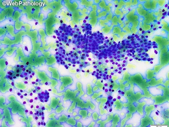 This is a light microscopy histology image of thyroid gland tissue prepared with a Romanowsky-type stain (e.g., Diff-Quik/Wright-Giemsa). The specimen shows normal-appearing follicular epithelium arranged in intact macrofollicles with abundant colloid occupying the luminal spaces. Follicular cells are evenly spaced with uniform, round to oval nuclei and scant to moderate cytoplasm, consistent with well-differentiated thyroid epithelium. The colloid background is pale blue and prominent, reflecting thyroglobulin-containing material released from follicles. The architectural pattern emphasizes large follicle units with a single layer of cuboidal to low-columnar epithelium surrounding expansive colloid pools. No prominent nuclear features of papillary carcinoma are evident, and there is no marked cellular atypia or mitotic activity in the visible fields. This image illustrates classic histology of benign thyroid tissue or colloid-rich goiter, useful for teaching follicular morphologies, thyroid folliculogenesis, and colloid dynamics. Clinically, such samples are evaluated in the context of thyroid nodules and goiter workups, with correlation to serum thyroid function tests and, when applicable, ultrasound or FNA findings. Potential educational uses include cytology-histology correlation, differential diagnosis of thyroid disease, and artifact recognition in Romanowsky-stained preparations. Images are suitable for medical education, pathology review, and database indexing. Correlative data improve student comprehension and diagnostic recall greatly.