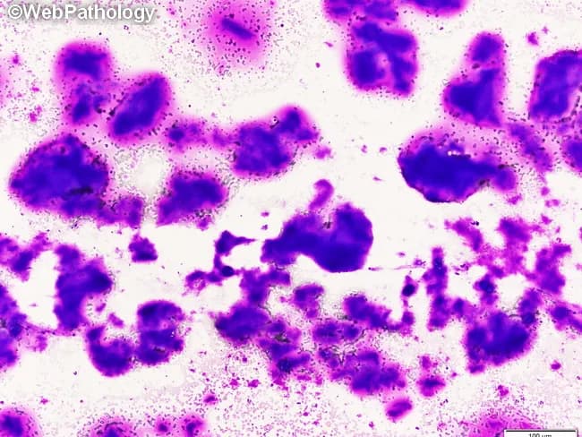 Imaging modality and technique: Light microscopy of a stained cytology smear from thyroid fine-needle aspiration (FNA). The specimen shows thyroid follicular cells set in a predominantly colloid-rich background, with occasional microfollicular clusters and scattered single cells. Staining: Papanicolaou stain, bright-field optics, high contrast between dense nuclear detail and translucent colloid. Anatomical context: endocrine organ pathology involving the thyroid gland in the anterior neck. The histologic plane is cytology; intact tissue architecture is limited, but overall cellularity is low-to-moderate with abundant colloid. Visual features: widespread, translucent, watery colloid covering large areas; occasional thick, opaque colloid with well-defined outlines; background may contain bubbles and folds; some circular or pseudopapillary arrangements can form; follicular cells display round to oval nuclei with even chromatin and inconspicuous nucleoli; lack of significant nuclear atypia is noted. Pathology and diagnostic relevance: colloid-rich aspirates with a high colloid-to-cell ratio are characteristic of benign thyroid nodules (colloid goiter) and hyperplastic nodules; differential considerations include follicular adenoma or carcinoma, but heavy colloid typically argues against malignancy. Clinical correlation: integrate with ultrasound nodule features, serum thyroid function tests, and repeat sampling if needed; educational value: reinforces FNAC interpretation and colloid morphology, including descriptors such as 'bubble-gum' colloid and translucent sliding film.