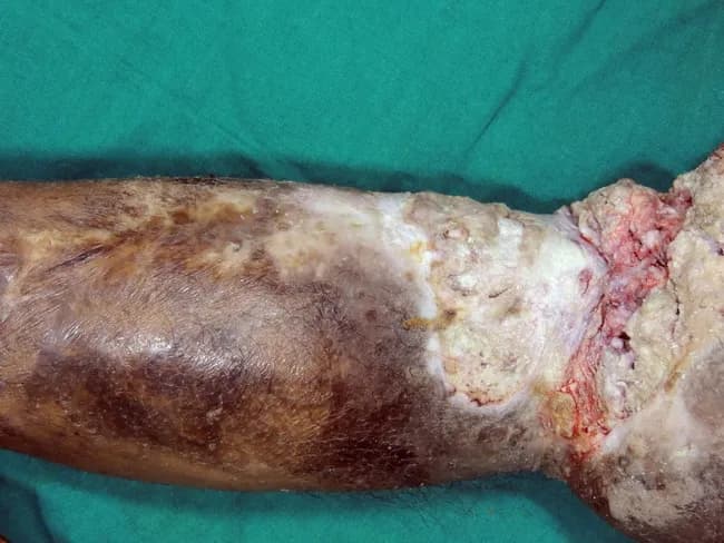This clinical gross photography depicts a distal thigh- to above-knee amputation stump with a chronically scarred, ulcerated soft tissue lesion consistent with Marjolin's ulcer arising in a prior traumatic scar. The overlying skin shows hyperpigmented, leathery areas with focal induration and necrotic regions at the margin of the scar, transitioning to healthier surrounding tissue. The lesion is exophytic and crateriform, with irregular, raised borders and crusting, extending into the scarred subcutaneous tissue. In many Marjolin's ulcers, the histology reveals squamous cell carcinoma, typically well differentiated, characterized by nests of malignant keratinocytes with possible keratin pearl formation and invasion into deeper dermis and subcutaneous planes; clinically, this entity bears a latent interval of years to decades after initial injury. This image emphasizes the aggressive behavior and potential for local invasion and regional spread despite a relatively well-differentiated phenotype. Clinical relevance includes recognition in chronic wounds or burn scars, necessity of complete excision with wide margins, and evaluation for nodal metastasis. In resource-limited settings, delayed presentation is common; in developed regions, modern wound care reduces incidence but vigilance remains essential for long-standing scars. This gross finding informs surgical planning, prognosis assessment, and multidisciplinary oncologic management including possible radiotherapy or extended resection.