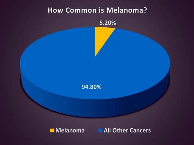 Infographic presenting melanoma prevalence as a population-level epidemiology chart. The image is a pie chart titled How Common is Melanoma?, with melanoma shown in yellow representing 5.20% and all other cancers shown in blue representing 94.80%. It summarizes contemporary United States cancer incidence, focusing on cutaneous melanoma relative burden. The data cited include melanoma’s share of new cancer cases (about five percent) and the 2017 projection of 161,790 new melanoma cases, comprising 74,680 in-situ and 87,110 invasive tumors, derived from National Cancer Institute and American Academy of Dermatology sources. The visualization emphasizes that melanoma, while a minority of total cancers, remains a critical public health concern due to its potential for metastasis, mortality, and survivorship considerations. The image supports dermatology, oncology, and public health education by providing a crisp numeric snapshot suitable for teaching, screening discussions, and patient counseling about risk factors, early detection, and prevention strategies, such as sun protection and skin checks. It is not a diagnostic image but an epidemiologic figure intended to contextualize risk and resource allocation. Clinicians may reference this type of infographic when communicating disease burden, guiding screening programs, or illustrating trends in melanoma incidence across populations and time, for education and research purposes.