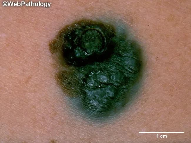Clinical photography of a cutaneous pigmented lesion consistent with superficial spreading melanoma in a vertical growth phase. The image captures a dark, irregular, macro-nodular area on the skin surface with two elevated blue-black nodules surrounded by a blue-brown macular component. The lesion demonstrates classic melanoma hallmarks: asymmetry, irregular borders with indentations, variable pigmentation from tan to black, and surface elevation with nodularity indicating invasion. The surrounding skin shows a slightly lighter, mottled halo reflecting partial regression or desmoplastic reaction. The nodules are firm to palpation, suggesting vertical growth depth into the dermis, which portends poorer prognosis compared with radial growth alone. The macular component likely corresponds to in-situ or superficial spreading melanoma areas with pigment production by malignant melanocytes. The pigmentation range includes blue-black melanin-rich regions and lighter tan or pink foci often associated with regression or reduced melanin production. On clinical evaluation, the combination of nodular invasion and irregular, scalloped margins supports a diagnosis of malignant melanoma rather than a benign nevus or scar. This photograph is valuable for teaching melanoma morphology, recognizing vertical growth phase, and supporting differential diagnosis including pigmented nevus, seborrheic keratosis, and amelanotic melanoma. Practical utility includes dermoscopic correlation, lesion monitoring, and surgical planning today.