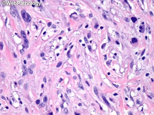 Brightfield light microscopy of an H&E-stained biopsy specimen reveals a loose to moderately dense fibrous stroma populated by scattered spindle-shaped fibroblast-like cells with elongated, oval nuclei and minimal cytoplasm. The cells are arranged in irregular, wavy cords within a pink eosinophilic collagen matrix, reflecting a desmoplastic-type reaction. Interspersed inflammatory elements include small lymphocytes and occasional plasma cells, consistent with a chronic or subacute process. In this field there is no obvious necrosis, and mitotic activity is not readily evident, arguing against high-grade malignancy in this limited view. Vascular channels are present but not markedly abnormal. The overall pattern suggests a fibroblastic or myofibroblastic proliferative process within connective tissue, with preserved tissue architecture and absence of overt differentiation toward epithelial, neural, or adipocytic lineages. Clinically, these features support differential diagnoses that include fibromatosis (desmoid-type), benign fibrous scar or granulation tissue, and low-grade fibrosarcoma; inflammatory myofibroblastic tumor remains a consideration, particularly in younger patients or when inflammatory infiltrate is prominent. Correlation with clinical history, imaging, and, if indicated, immunohistochemical staining (e.g., SMA, desmin, CD34, Ki-67) is recommended to refine diagnosis and guide management. Imaging-pathology concordance is essential for definitive classification and subsequent therapeutic planning, including surgical excision or observation, and multidisciplinary discussion.