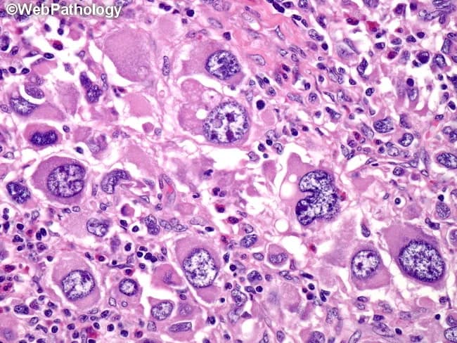 Histology image obtained with brightfield light microscopy on a hematoxylin and eosin stained tissue section. The specimen shows granulomatous inflammation characterized by aggregates of epithelioid macrophages (histiocytes) with elongated, pale to eosinophilic cytoplasm. Multinucleated giant cells, occasionally Langhans-type with peripheral, radiating nuclei, are interspersed among the epithelioid cells. Surrounding lymphocytes and a sparse fibrous stroma delineate nodular granulomas. In some fields there are crystalline or granular pink to eosinophilic deposits within the cytoplasm of histiocytes, and there may be mild necrosis at the center of larger granulomas, though necrosis is not uniformly present across the slide. The pattern is compatible with a granulomatous infectious or inflammatory process, requiring clinical correlation and microbiologic assessment. Differential diagnoses include mycobacterial infection (tuberculosis), fungal granulomas (histoplasmosis, blastomycosis), sarcoidosis, and foreign-body granulomatous reactions. The image emphasizes a macrophage-dominant infiltrate with discrete nodular architecture, preserving basic tissue planes while revealing cellular detail such as nuclear atypia is not prominent. This histologic phenotype is critical for guiding targeted tests (AFB stain, fungal stains, PCR) and therapeutic decisions, and it serves as an educational reference for recognizing granuloma formation in biopsy specimens. Correlation with clinical history and imaging is essential for diagnosis.