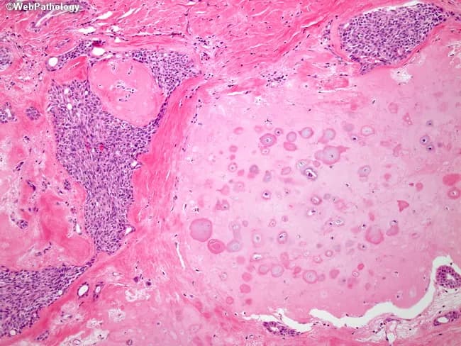 Light microscopy of a hematoxylin and eosin stained section of salivary gland tissue (parotid region) demonstrates a well-defined lobular architecture composed of chondroid (chondromyxoid) material embedded in hyalinized stroma. The epithelial component forms duct-like structures and nests, while the surrounding spindle-to-plasmacytoid myoepithelial cells exhibit diverse morphologies, including epithelial, clear cell, and hyaline (plasmacytoid) differentiation. This biphasic pattern, with intimate admixture of myoepithelial elements and a cartilaginous-like stroma, is characteristic of a benign mixed tumor, pleomorphic adenoma. The chondromyxoid matrix shows variable basophilia and occasional chondral calcifications, though limited cytologic atypia is typical. The lesion is usually well circumscribed within the glandular parenchyma, and mitotic activity is low. Immunohistochemical profiling may reveal p63 and cytokeratin positivity in the myoepithelial cells with S100 protein labeling in the myxoid stroma, supporting diagnosis. Clinically this finding correlates with a slow-growing, painless mass in the salivary gland region, most commonly the parotid. Diagnostic significance lies in distinguishing pleomorphic adenoma from malignant salivary gland tumors such as adenoid cystic carcinoma or mucoepidermoid carcinoma, guiding management toward conservative surgical excision with clear margins. The image is educational for histopathology, surgical pathology, and oral and maxillofacial pathology curricula.