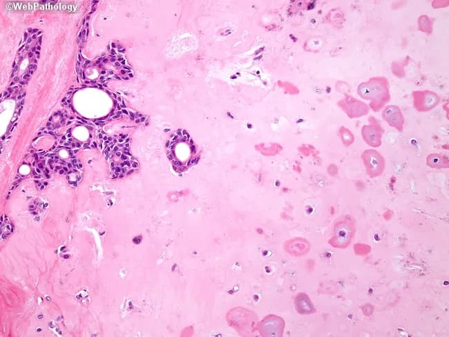 High-power histopathology micrograph of a salivary gland lesion stained with Hematoxylin and Eosin (H&E). The section shows a classic pleomorphic adenoma with biphasic differentiation: ducts lined by a single layer of cuboidal-to-columnar epithelial cells forming small ductal structures, and a dispersed population of plump, bland myoepithelial cells. The stroma is distinctly chondroid and myxoid, producing a cartilaginous, basophilic matrix that mingles with epithelial elements. The epithelial cells display uniform cytomorphology, with minimal mitotic activity and no overt nuclear pleomorphism or atypia. The lesion is well circumscribed within the glandular parenchyma, containing islands of neoplastic epithelium embedded in an abundant chondromyxoid matrix. Some ducts are inconspicuous, others form back-to-back clusters; mucinous secretions are not prominent. The overall impression is of a benign mixed tumor, commonly known as pleomorphic adenoma, characterized by a spectrum of architectural patterns including ductal epithelium and chondroid stroma. Diagnostic significance lies in recognizing the characteristic stromal heterogeneity and bland cytology, which differentiate it from malignant salivary gland neoplasms such as mucoepidermoid or adenoid cystic carcinoma. These findings underpin surgical planning and prognosis, with emphasis on complete excision to minimize recurrence risk. The sample’s architecture underscores the tumor’s benign behavior and guides conservative, organ-preserving resection in this case.