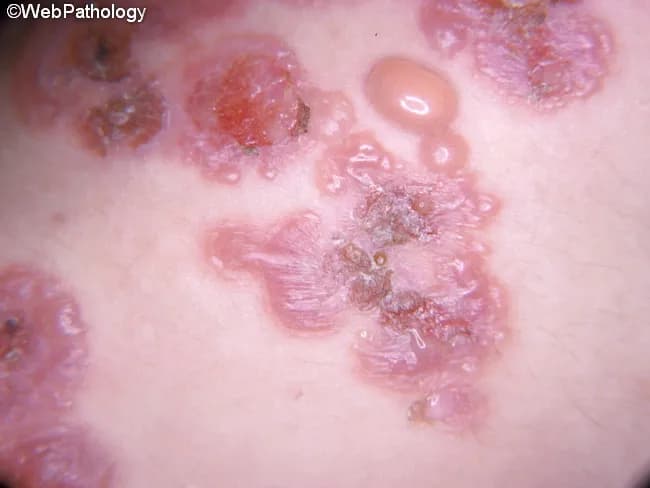 Clinical photography of dermatitis herpetiformis illustrating a typical cutaneous eruption associated with gluten sensitive enteropathy. This in vivo macroscopic dermatology photograph shows clustered intensely pruritic lesions on extensor surfaces. The distribution is symmetrical, involving elbows and knees with additional involvement of buttocks, scapular and sacral regions; face and scalp may be affected in some cases. Lesions comprise erythematous papules with small firm topped vesicles atop plaques, often with urticarial morphology and surrounding excoriations from scratching, leading to crusted erosions. Morphologic features include grouped vesiculopapular lesions in a pruritic distribution. Clinically this dermatitis herpetiformis is strongly associated with gluten sensitive enteropathy and antibodies to transglutaminases. Pathophysiology involves IgA autoantibodies depositing in the tips of dermal papillae; biopsy when performed can reveal neutrophilic microabscesses at papillary tips and dermal neutrophilic eosinophilic infiltrates, while direct immunofluorescence shows granular IgA deposits at dermal papillae tips with C3. The condition often follows a prolonged course but may remit; treatment includes dapsone or sulfapyridine and a strict gluten free diet. This image supports educational emphasis on clinical diagnosis, differential considerations bullous diseases and dermatitis herpetiformis mimics, and management implications. Clinical correlation with serology and biopsy confirms diagnosis and guides therapy.