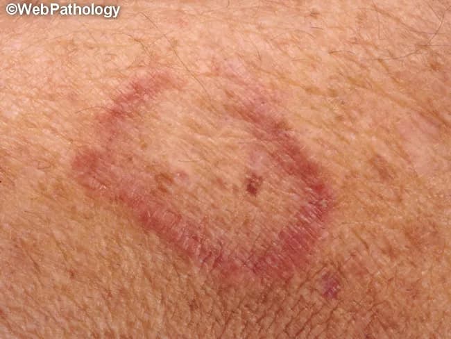Clinical photograph of a cutaneous lesion illustrating a well‑circumscribed annular plaque with central clearing. The image shows a pink‑red, slightly raised border with fine desquamation against a moderately pigmented skin background. The central area is less inflamed and relatively pale, giving the classic ring‑like (annular) appearance. The lesion is non‑uniform in texture, with mild surface scaling along the active border. Such features are highly suggestive of superficial dermatophyte infection, most consistent with tinea corporis (ringworm) involving the trunk or proximal limbs. Differential considerations include granuloma annulare, nummular dermatitis, and less likely psoriasis with annular morphology. The color and margin support fungal etiology, but confirmation requires mycological testing (potassium hydroxide preparation, fungal culture) or dermoscopy in some settings. Clinically relevant findings include pruritus and possible exposure to infected individuals or animals; lesions typically respond to topical antifungals (terbinafine, itraconazole if extensive) and environmental hygiene measures. This image is suitable for dermatology education, medical student dermatology training, and research on cutaneous fungal infections, differential diagnosis instruction, and exam prep. The content emphasizes macroscopic morphology, border architecture, and central clearing as critical diagnostic cues. This description complements pathology reports by correlating clinical appearance with expected histologic features if biopsy were performed later.