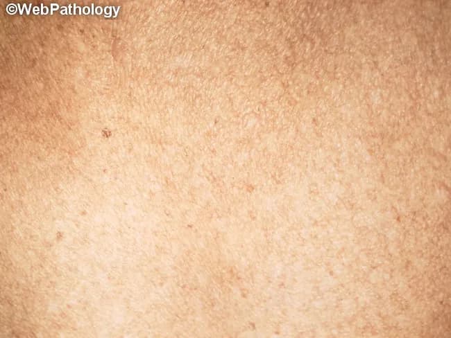 This clinical dermatologic photograph depicts chronic arsenic-related skin pigmentation. Modality: clinical photography; technique: gross macro image with standard lighting. The skin surface shows diffuse, mottled hyperpigmentation characterized by numerous small, irregular brown-to-slate macules and patches arranged in a raindrop pattern across the trunk and proximal extremities. Borders are variable, with some coalescing into larger pigmented fields; texture remains largely normal but may appear slightly rough in exposed areas. The appearance is typical of long-standing arsenic exposure from contaminated groundwater and is often accompanied by palmoplantar keratoses (not shown here). The color contrast between pigmented and adjacent normal skin is pronounced, aiding recognition. Pathophysiology involves arsenic-induced dysregulation of melanocyte activity and epidermal changes, producing “raindrop” hyperpigmentation that may herald cutaneous malignancy risk (basal cell carcinoma, squamous cell carcinoma) with chronic exposure. Clinical significance includes confirming exposure history, guiding public health intervention, and prompting systemic evaluation for arsenic-related toxicity. Differential considerations include postinflammatory hyperpigmentation, tinea versicolor, solar lentigines, and other drug- or metal-induced pigmentary disorders. Clinical correlation with urinary, hair, or nail arsenic levels is recommended, along with surveillance for Mees’ lines and hyperkeratosis. This image is valuable for education, toxicology, environmental health, and dermatology curricula. Useful for clinical training and health.