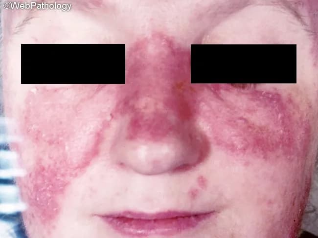 Comprehensive Description: This clinical dermatology photograph depicts the classic malar, or butterfly, rash of systemic lupus erythematosus (SLE). Modality: Clinical photography of facial skin in a frontal/anterior view. The malar distribution spans the nasal bridge and both malar prominences with symmetric erythematous, violaceous, and edematous plaques. The skin surface appears mildly scaly in places, and photoexposed regions may show accentuated erythema consistent with photosensitivity. The nasolabial folds are relatively spared in this pattern, and the overall appearance supports cutaneous lupus erythematosus when correlated with systemic signs. While not pathognomonic, the image demonstrates a prototypical manifestation that can mimic rosacea, dermatitis, or dermatomyositis, emphasizing the importance of clinical context and serologic testing for diagnosis. Alopecia or scarring alopecia may accompany cutaneous disease but is not evident in this frame. This photo highlights the diagnostic significance of a photosensitive, malar eruption and its role in assessing disease activity and treatment response. Potential clinical uses include dermatology and rheumatology education, reference for malar rash recognition, differential diagnosis training, and documentation for patient counseling and longitudinal follow-up. The image also serves as a teaching aid for recognizing sun-induced exacerbations, differentiating inflammatory rashes, and discussing psychosocial impact and cosmetic considerations in lived care for SLE patients.