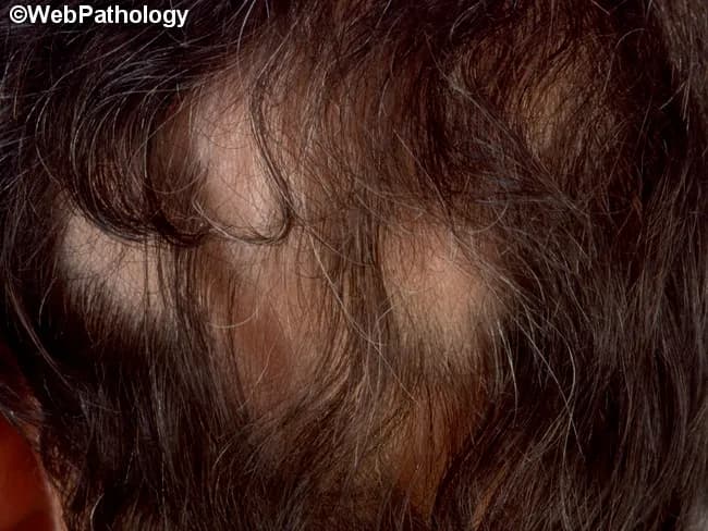 Clinical photography of the scalp reveals a single, well-demarcated patch of alopecia approximately X cm in diameter, with overlying mild to moderate scaling and marginal hair follicle disruption. The patch is hypo-hyperpigmented relative to surrounding skin. Hair within the patch is sparse with broken hair shafts. The lesion is round/oval, with a slightly raised, scaly border and no obvious crusting or pustulation. The surrounding scalp shows normal hair density and no additional patches. The appearance is classic for inflammatory hair loss due to dermatophyte infection (tinea capitis) or, less commonly, alopecia areata with background scale. The presence of scale and patchy hair loss increases suspicion for tinea capitis, particularly in children, and warrants mycological confirmation via KOH prep or fungal culture, as well as possibly wood lamp examination for fluorescing species. Differential diagnosis includes alopecia areata, seborrheic dermatitis, psoriasis, lupus-related scalp involvement, and traction alopecia. In clinical practice, the finding would prompt dermatologic examination, fungal testing, and initiation of antifungal therapy if confirmed. Clinically relevant features include perifollicular scaling, endothrix or ectothrix hair invasion not visible on gross inspection, and potential secondary bacterial infection if excoriation is present. This image demonstrates essential gross morphology for educational references and diagnostic pattern recognition.