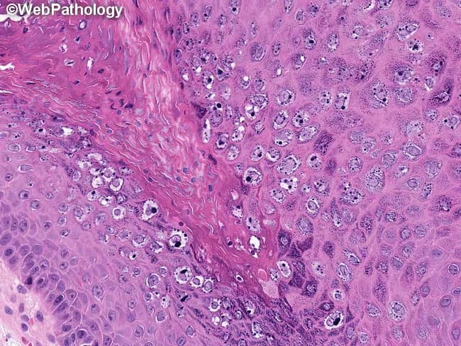 Histology of a common cutaneous wart (Verruca vulgaris) presenting in a hematoxylin and eosin stained slide viewed under light microscopy at high magnification. The specimen originates from skin biopsy with epidermal and superficial dermal involvement. The epidermis shows marked acanthosis with pronounced papillomatosis and irregular thickening of rete ridges. The upper epidermal layers contain numerous koilocytes—keratinocytes with enlarged, raisinoid nuclei surrounded by clear halos—and there is conspicuous cytoplasmic clearing and perinuclear halos. Basophilic keratohyalin granules are abundant in the granular layer, giving the granular layer a dark basophilic appearance. Hyperkeratosis and focal parakeratosis are evident in the stratum corneum, with mild epidermal spongiosis and dermal inflammatory infiltrate composed of lymphocytes and rare neutrophils. The dermal-epidermal junction is not disrupted, consistent with benign HPV-induced hyperproliferation. These features collectively support verruca vulgaris: HPV infection of keratinocytes leading to hyperplasia, koilocytosis, and a papillary surface. Clinically, verruca vulgaris is contagious, often skin-to-skin transmitted, frequently arising in children and young adults, and commonly treated with cryotherapy, salicylic acid, or immunomodulators. Differential diagnoses include seborrheic keratosis and squamous cell carcinoma; however, absence of atypia and invasion supports benign wart. The histopathology correlates with clinical management decisions and prognosis.