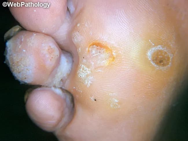 Clinical photography of a plantar foot displaying a verruca plantaris (plantar wart). Modality is a high‑quality gross image used in dermatology documentation. Precise location is the plantar surface of the foot (sole), with a focal, endophytic lesion that is rough and hyperkeratotic. Visual features include a circular to oval papule with a central crater or indent, irregular surface texture, and surrounding callus‑like thickening. Punctate black dots representing thrombosed capillaries may be seen within the lesion, while surrounding epidermis shows white scaling and fissuring. The lesion is typically mildly elevated above the surrounding skin and may be tender with pressure; it often coexists with other warts on the same sole. The clinical impression is verruca plantaris caused by human papillomavirus infection, with characteristic epidermal hyperplasia, papillomatosis, and hyperkeratosis evident on gross inspection. Differential diagnoses include callus/corn, plantar keratoderma, and foreign body reaction; histology would show koilocytosis and viral cytopathic effects if examined. This image supports clinical decision making, differential diagnosis, and treatment planning (topical salicylic acid, cryotherapy, or laser), and serves as an educational reference for students, residents, and clinicians evaluating plantar lesions. Clinical correlation includes assessing for additional lesions and patient history of HPV exposure; follow-up imaging is not required.