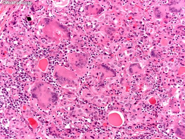 This case utilizes light microscopy of thyroid tissue stained with Hematoxylin and Eosin. The high-magnification image reveals granulomatous thyroiditis characterized by numerous foreign body giant cells and a dense chronic inflammatory infiltrate composed of lymphocytes and plasma cells. Interspersed is residual thyroid parenchyma containing colloid-filled follicles, some diminished or disrupted by inflammation. The tissue architecture shows granulomas centered around disrupted colloid with multinucleated giant cells phagocytosing colloid material, a classic appearance of subacute granulomatous (de Quervain) thyroiditis. There is relative preservation of overall gland structure with focal areas of follicular destruction. These features distinguish subacute thyroiditis from autoimmune thyroiditis (Hashimoto) and bacterial abscesses. Clinically, this pattern correlates with a transient thyrotoxic phase followed by hypothyroidism in many patients; HLA-B35 haplotype association has been reported; etiology often linked to viral trigger; most cases resolve with supportive care. The image supports diagnosis of granulomatous thyroiditis in the appropriate clinical context, guiding management toward observation and symptomatic treatment. This histology is relevant for education in endocrine pathology, differential diagnosis of thyroiditis, and research into post-viral inflammatory thyroid injury. The depiction is representative for pathology teaching slides and radiology correlations in endocrinology. Educational value for residents, fellows, and medical students with accurate histology correlations.