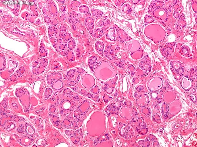 Imaging modality: Light microscopy of thyroid tissue section stained with Hematoxylin and Eosin. Specimen type: thyroid gland biopsy evaluated histologically. Imaging perspective: high-power microscopic view. Anatomical context: thyroid in the neck. Core histology demonstrates diffuse follicular hyperplasia with marked hypercellularity and reduced colloid throughout the gland. Follicles are small, compact, and tightly spaced, with scant colloid and thickened follicular epithelium. The epithelial cells show pronounced cytologic atypia, including bizarre hyperchromatic nuclei, a finding that can simulate neoplasia but is characteristic in dyshormonogenetic goiter due to inborn errors of thyroid hormone synthesis. This pattern is typically diffuse rather than nodular. Clinical significance: these histologic features correlate with congenital or neonatal hypothyroidism in severe cases and with goiter and mild hypothyroidism in milder forms; many patients present by approximately 25 years of age. Diagnostic relevance: supports dyshormonogenesis as an underlying cause of diffuse thyroid enlargement with impaired hormone production. Differential considerations include autoimmune thyroiditis and other causes of diffuse goiter; correlation with thyroid function tests and clinical history is essential. Potential clinical uses: diagnosis of dyshormonetic goiter, gene-level counseling, and guidance of hormone replacement therapy. This histology aids educational cases and research on thyroid hormone synthesis disorders, and informs patient management strategies.