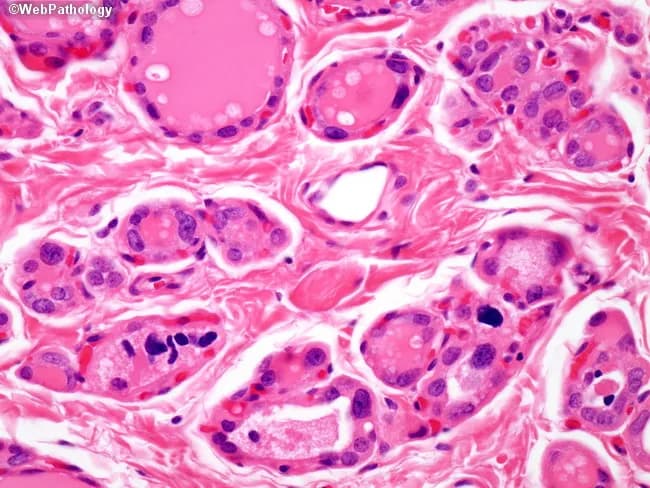 This is a light-micrograph of thyroid parenchyma illustrating dyshormonogenetic goiter with prominent cytologic atypia in follicular cells. Acquired from a thyroid tissue specimen, the slide is stained with Hematoxylin and Eosin (H&E) and examined at high magnification under light microscopy. The architectural pattern shows numerous small follicles embedded in a fibrous stroma with variable colloid content and papillary-like nuclear changes. Follicular cells display marked variation in size and shape, hyperchromatic nuclei, nuclear crowding, and occasional grooves or grooves-like features that can mimic papillary carcinoma. The presence of abundant cytoplasm, irregular nucleo-cytoplasmic borders, and pseudoinclusions contribute to diagnostic confusion. In dyshormonogenetic goiter, these cytologic changes can be striking, and in up to about 20% of cases may lead to misinterpretation as follicular, papillary, medullary, or undifferentiated carcinoma, underscoring a clinically significant pitfall. Notable benign features include preservation of follicular arrangement, presence of colloid within many follicles, and absence of unequivocal invasion or stromal desmoplasia. This image highlights the key diagnostic challenge: the need to differentiate benign dyshormonogenetic changes from malignant thyroid neoplasia on cytology or limited histology. Clinically, dyshormonogenesis is associated with congenital hypothyroidism and goiter; diagnosis relies on correlating cytology with clinical data, family history, and, when needed, molecular testing.