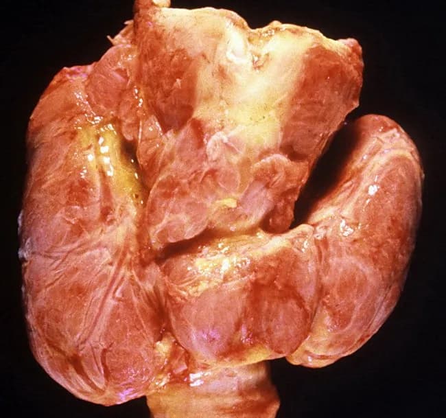 Imaging modality and technique: Gross autopsy photograph of the thyroid gland. The view is a frontal, macroscopic examination of the neck showing diffuse enlargement of both lobes with smooth surfaces and no discrete nodules. The tissue is pink to tan with subtle lobular architecture preserved. This gross appearance corresponds to diffuse hyperplasia and hypertrophy of thyroid follicles seen in Graves disease, producing a diffusely enlarged, symmetric goiter. There are no focal masses or inflammatory lesions evident in this specimen. Clinically, Graves disease is an autoimmune thyrotoxicosis characterized by endogenous hyperthyroidism, ophthalmopathy (exophthalmos), and dermopathy; the autopsy image reflects the thyroid component of that syndrome. Pathophysiology involves stimulation by thyroid-stimulating immunoglobulins that drive diffuse follicular hyperplasia and increased thyroid hormone synthesis. The gross findings support laboratory and clinical data such as suppressed TSH and elevated free T4/T3. Epidemiology notes peak incidence in females aged 20–40 years, with female-to-male ratio ≈10:1. This photograph is valuable for teaching gross pathology, correlating macroscopic thyroid changes with endocrinologic manifestations, and differentiating Graves disease from nodular goiters or thyroiditis in educational and research settings. It also highlights the importance of autopsy correlations in endocrine pathology. Educational utility.