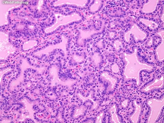 Imaging modality: light microscopy of hematoxylin and eosin–stained thyroid tissue sections. Primary subject: thyroid follicular epithelium with colloid-filled follicles. Anatomical context: thyroid gland parenchyma in the cervical region, showing follicles lined by tall columnar epithelium. Morphology: hypercellular epithelium with marked nuclear crowding creates papillary infoldings that protrude into the glandular lumens. Pale colloid is present within the follicles and margins appear scalloped. In architectural detail, papillary projections resemble papillary thyroid carcinoma but lack true fibrovascular cores, a key differentiator on histology. The follicular lumens vary in size, and colloid shows scalloping margins, consistent with benign activity rather than malignant invasion. Cytologic features include elongated nuclei with ovoid contours and scant cytoplasm; mitotic activity is not conspicuous. Immunophenotype is not assessed in this image; histology alone raises diagnostic considerations of benign hyperplastic changes including nodular hyperplasia or benign follicular adenoma with papillary-like infoldings. Diagnostic significance: recognition of papillary-like architecture without fibrovascular cores reduces the likelihood of classic papillary thyroid carcinoma, and highlights the need for correlating with nuclear features and ancillary studies. This image is relevant for surgical pathology reference, education, and differential diagnosis training in endocrine pathology. These considerations are essential for resident education, diagnostic conundrums, and interdisciplinary tumor boards.