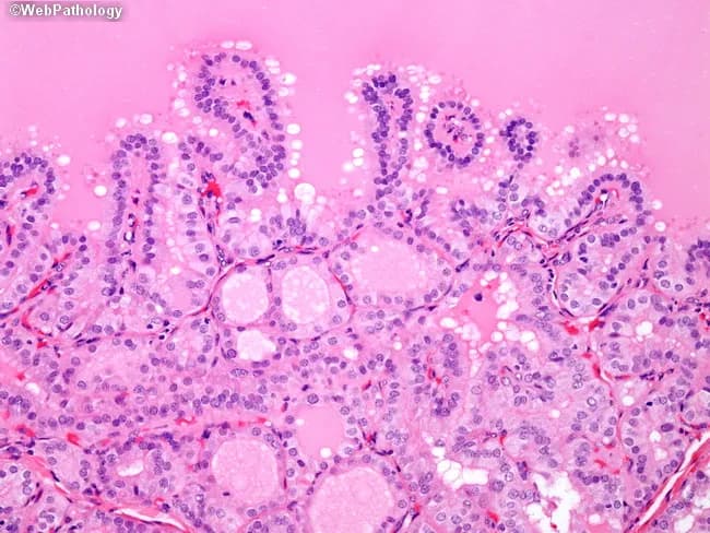 Thyroid gland histology section examined under light microscopy with Hematoxylin and Eosin stain. The thyroid follicles show marked epithelial hyperplasia with crowding of nuclei, producing papillary-like folds into the colloid. This pattern occurs in Graves disease and reflects hormonally driven follicular hyperplasia rather than neoplastic papillary thyroid carcinoma. Notable features include focal papillary infoldings with absence of malignant nuclear characteristics such as grooves, inclusions, or clearing. Clinical context typically reveals hyperthyroidism, with low TSH and elevated thyroid hormones. The changes are autoimmune-mediated, driven by thyroid-stimulating immunoglobulin (TSI) stimulating TSH receptors, leading to diffuse follicular enlargement and increased colloid turnover. In the absence of carcinoma-associated nuclear morphology, these findings should not be misinterpreted as papillary thyroid carcinoma. The image highlights how architectural changes can mimic neoplasia while lacking PTC cytology. Differential considerations include papillary carcinoma, nodular goiter, and thyroiditis; the decisive factors are epithelial architecture and nuclear phenotype. This histology is clinically significant to avoid overtreatment and guide management such as antithyroid therapy, radioiodine, or surgery based on clinical and biochemical context. Educationally, it supports pathology training, radiology-pathology correlation, and recognition of Graves-associated thyroid changes in suspected hyperthyroid patients. Correlate with serology and imaging for comprehensive patient assessment. With clinical correlation.