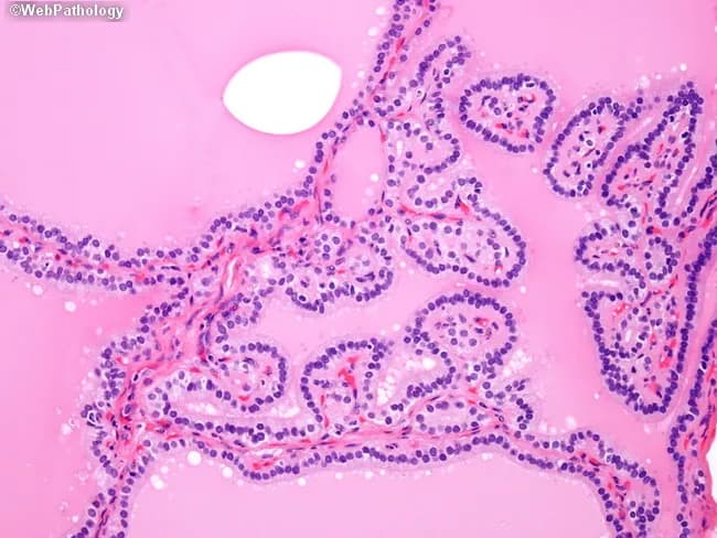This is a brightfield, hematoxylin and eosin stained histology slide of thyroid tissue examined by light microscopy at high magnification. The specimen is thyroid gland parenchyma showing diffuse follicular hyperplasia characteristic of Graves disease. Follicles appear crowded with epithelial cells lining irregular, papillary-like folds protruding into the lumen, creating pseudo-papillary architectures that could mimic papillary thyroid carcinoma if evaluated in isolation. The nuclei within the thyrocytes are hyperplastic and dense but lack the distinctive nuclear features of papillary carcinoma, such as crowding with nuclear grooves, inclusions, Orphan Annie eye clearing, and powdery chromatin. Colloid is variably present or scant; stroma is vascular, and the overall architecture is polyfollicular with ingrowths into luminal spaces. This pattern reflects autoimmune-driven stimulation by TSH receptor autoantibodies (e.g., thyroid-stimulating immunoglobulin), resulting in diffuse goiter with hyperthyroid state. Clinically, Graves disease presents with weight loss, tachycardia, heat intolerance, and sometimes exophthalmos; histology aids diagnosis when correlated with serology and uptake studies. Key diagnostic significance: avoid mislabeling as papillary thyroid carcinoma; rely on clinical context and absence of malignant nuclear features. Potential educational uses include differential diagnosis training for thyroid pathology, immune-mediated thyroid hyperplasia vs neoplasia, and radiology-pathology correlation. This image supports teaching clinics and pathology review conferences.