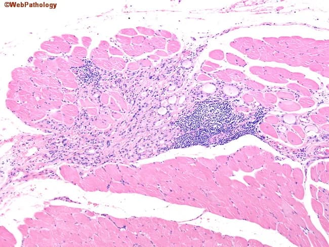This light-microscopy histology image shows ectopic thyroid tissue infiltrating neck striated muscle in the setting of Graves disease. A transverse, low-magnification view stained with Hematoxylin and Eosin reveals multiple well-formed thyroid follicles lined by tall, crowded epithelium with reduced or scant colloid, consistent with follicular hyperplasia. The ectopic follicles are embedded within skeletal muscle fibers, separated by fibrous septa and mild edema. A dense lymphoid infiltrate with germinal centers envelops the ectopic tissue, reflecting autoimmune stimulation and chronic inflammation typical of Graves disease. The architecture demonstrates hyperplasia of thyroid parenchyma outside the orthotopic gland, an unusual but described phenomenon whereby hyperplastic ectopic follicles are more conspicuous in the neck due to autoimmune activity. Notable features include juxtaposition of thyroid epithelium with muscle fibers, occasional papillary infolding of the follicular epithelium, and scant colloid. The diagnostic significance lies in recognizing ectopic thyroid involvement in autoimmune thyroid disease, which may impact localization, surgical planning, and interpretation of neck masses. Differential considerations include Hashimoto thyroiditis-related changes, nodular goiter with ectopia, thyroglossal duct remnants, or metastatic thyroid carcinoma to muscle. Clinically, correlates with hyperthyroidism and elevated thyroid antibodies; imaging and serology aid comprehensive assessment.