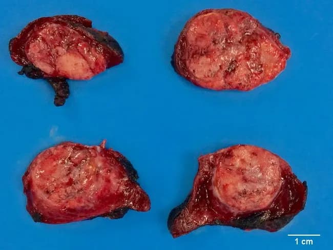 This gross pathology photograph shows four cross-sectional views of a thyroid tumor resected from the neck in a patient with medullary thyroid carcinoma. Imaging modality: gross surgical pathology photography; blue background and a 1 cm scale bar provide size reference. The four specimens display solid, tan-gray to pink-tan nodules with lobulated contours and variable firmness. Cut surfaces reveal heterogeneous texture with pale, fibrous to yellowish tissue and focal hemorrhagic areas; margins appear irregular, reflecting tumor invasion into adjacent thyroid parenchyma. Overall architecture shows complete or near-complete replacement of normal thyroid tissue by focal to multifocal neoplastic nodules. While definitive diagnosis requires microscopic evaluation, these gross features are compatible with a malignant neuroendocrine neoplasm of parafollicular C-cell origin. Medullary thyroid carcinoma often demonstrates pale, tan to gray cut surfaces with firm consistency and gross heterogeneity; histology typically shows nests of polygonal cells with amyloid stroma and calcitonin immunoreactivity. Clinically, MTC may secrete calcitonin and CEA and is associated with MEN2 syndromes; surgical management and prognosis hinge on stage and nodal involvement. This image is valuable for education on gross morphology, differential diagnosis versus papillary, follicular, and anaplastic carcinomas, and for correlating gross findings with radiologic and histopathologic workflows.