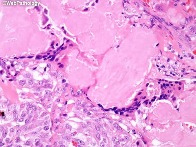 Histology image obtained from thyroid tissue showing medullary thyroid carcinoma with extracellular amyloid deposits in the tumor stroma and a foreign body-type giant cell reaction surrounding the amyloid. The slide is a paraffin-embedded tissue section stained with Hematoxylin and Eosin, visualized under light microscopy. The malignant parafollicular C-cells form nests and sheets with uniform, round to polygonal cells and granular cytoplasm, displaying salt-and-pepper nuclear characteristics. A conspicuous, pink, amorphous extracellular matrix represents calcitonin-derived amyloid within and around tumor nests; multinucleated giant cells and macrophages are present at the periphery, reflecting a foreign body-type granulomatous response to amyloid deposition. Congo red staining (not shown here) would typically reveal apple-green birefringence under polarized light, confirming amyloid. This histology is characteristic of medullary thyroid carcinoma (MTC) and helps distinguish it from papillary, follicular, or anaplastic thyroid cancers. Diagnostic significance rests on the co-occurrence of C-cell neoplasia and amyloid, a hallmark of MTC, with possible associations to calcitonin gene-related peptide and RET oncogene alterations. Clinically, MTC presents with a neck mass and elevated serum calcitonin and CEA; amyloid-rich stroma reflects tumor biology and has prognostic implications. The image supports educational and diagnostic use in pathology, endocrine oncology, and medical education.