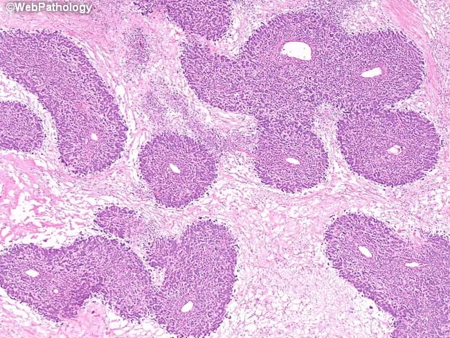 Imaging modality and technique: Brightfield light microscopy of a hematoxylin and eosin stained pancreatic tissue section. The specimen presents pancreatic parenchyma with distinct islets of Langerhans embedded within predominantly acinar lobules. The islets appear as pale, rounded to oval nests that contrast with the surrounding basophilic exocrine cells, producing a characteristic lobulated architecture. Within each islet, endocrine cells display small to medium-sized nuclei with finely dispersed chromatin and scant cytoplasm, arranged in cords and clusters separated by delicate stromal septa. Ductal profiles and occasional small ducts are visible at the periphery, reflecting normal pancreatic histology. The exocrine component is highly cellular, with densely staining acinar cells and visible zymogen-containing granules; connective tissue septa provide lobular delineation. There is no obvious cytologic atypia, mitotic activity, or invasion; no confluent tumor masses are evident. The regional morphology is consistent with healthy pancreatic tissue or benign variation in islet density. This image is valuable for education on endocrine–exocrine pancreatic architecture, comparative pathology, and teaching of islet distribution, size variability, and relationships to exocrine pancreatic tissue. Potential clinical relevance includes assessment of endocrine function and differentiation from islet cell neoplasms in surgical specimens. Interpretations should consider patient history, laboratory data, imaging correlation and context.