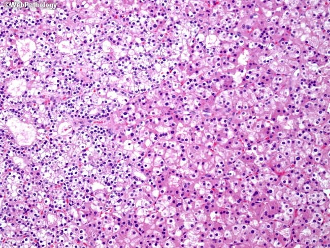 Imaging modality: Light microscopy of Hematoxylin and Eosin stained parathyroid tissue section (parathyroid adenoma). Anatomy: parathyroid gland within the cervical neck, typically near the thyroid; left half features sheets of chief cells; right half shows oxyphil cells; other cell types include water-clear cells and transitional cells. Histology: chief cells with amphophilic to lightly eosinophilic cytoplasm and conspicuous intracellular lipid/fat droplets; oxyphil cells with abundant granular eosinophilic cytoplasm and small pyknotic nuclei; cytoplasmic features reflect numerous mitochondria; cellular arrangement is lobular and highly cellular; vascular stroma is variable; fatty stroma reduced relative to normal parathyroid tissue. Pathology: parathyroid adenoma characterized by clonal proliferation of chief cells with admixture of oxyphil and water-clear cells; cytologic atypia minimal; mitotic activity low; absence of invasive growth in typical cases; indicates benign neoplasm; clinical correlation: hyperparathyroidism due to autonomous parathyroid hormone secretion; diagnostic significance includes correlation with elevated PTH and calcium levels; differential diagnoses include parathyroid hyperplasia, parathyroid carcinoma, and non-neoplastic thyroid tissue; educational use: illustrates cellular heterogeneity and diagnostic features used to differentiate hyperplasia from adenoma by architectural pattern, fat content, and cytoplasmic characteristics; suitable for pathology teaching, exam review, and database annotation. Representative images aid learners in recognizing parathyroid neoplasia and guiding surgical management.