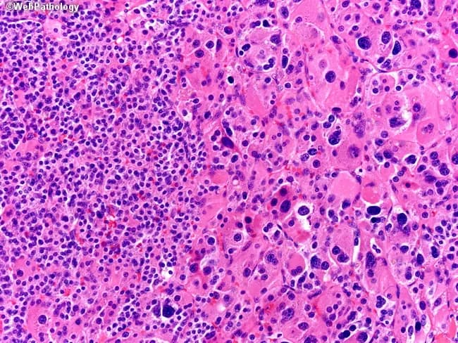 This histopathology image portrays a hematoxylin and eosin (H&E) stained parathyroid tissue section examined under bright-field light microscopy at approximately 400x magnification. The left hemisphere emphasizes small, uniform chief cells arranged in cords and granular cytoplasm with round to ovoid nuclei and inconspicuous nucleoli, consistent with typical parathyroid parenchyma. The right hemisphere shows oxyphil cells characterized by larger size, abundant eosinophilic cytoplasm, and markedly enlarged, hyperchromatic nuclei; these cells can occur as a normal variant in mature parathyroid glands. Adipose stroma is variably present, reflecting age-related involution of parathyroid tissue. There is no cytologic atypia, mitotic index is low, and there is no evidence of capsular or vascular invasion. Mitotic figures may occasionally appear but are not increased, aligning with benign histology. The overall architecture is preserved without destructive growth patterns, supporting a benign interpretation rather than neoplasia such as parathyroid adenoma or carcinoma. This image is suitable for educational comparisons of parathyroid cellular phenotypes (chief vs oxyphil cells) and for teaching differential diagnosis between normal histology and pathology requiring clinical correlation, including primary hyperparathyroidism, parathyroid adenoma and hyperplasia. Clinically, recognizing these normal parathyroid variants avoids misdiagnosis of neoplasia and guides correlation with serum calcium and parathyroid hormone (PTH) levels and imaging findings when indicated.