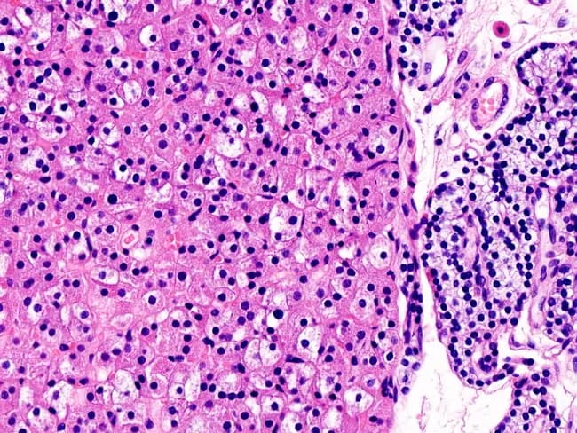 This is a light microscopic histology image of parathyroid tissue stained with hematoxylin and eosin (H&E). The left side shows an oxyphil cell–rich parathyroid adenoma characterized by sheets and cords of large, polygonal cells with abundant eosinophilic cytoplasm and centrally located round to ovoid nuclei. The dense eosinophilic cytoplasm is due to abundant mitochondria, giving the cells a characteristic acidophilic appearance. The stroma is relatively scant, with delicate capillary networks and minimal hematopoietic infiltration. A normal parathyroid gland is visible on the right for comparison, containing smaller, less eosinophilic chief cells arranged in cords with lighter cytoplasm and a richer vascular stroma. The juxtaposition helps distinguish adenomatous parathyroid tissue from normal parenchyma. Clinically, oxyphil cell–predominant adenomas can cause primary hyperparathyroidism, though nonfunctional adenomas exist. Pathology notes include a well-circumscribed lesion lacking significant mitotic activity or atypia, consistent with benign parathyroid adenoma rather than carcinoma. This image is valuable for educational purposes in surgical pathology, endocrine pathology, and histology training, illustrating cellular morphology, dysplastic features, and differential diagnosis with parathyroid hyperplasia. Correlation with serum calcium, parathyroid hormone levels, and radiological localization studies is recommended in clinical workups. It also aids understanding of oxyphilic differentiation and benign behavior in educational settings today.