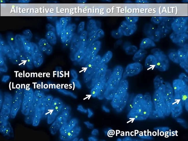 Fluorescence in situ hybridization (FISH) image of pancreatic neuroendocrine tumor tissue illustrating the alternative lengthening of telomeres (ALT) phenotype. Telomere probes labeled with green fluorescence highlight telomeric sequences within interphase nuclei on a blue DAPI counterstain, with arrows pointing to prominent ultrabright nuclear signals characteristic of ALT. This pattern reflects telomere maintenance independent of telomerase, commonly observed in PanNETs that harbor DAXX or ATRX pathway alterations and correlates with chromatin remodeling defects. The accompanying text notes that approximately 43% of PanNETs show mutually exclusive mutations in DAXX or ATRX, and that loss of their nuclear expression by immunohistochemistry can accompany ALT detected by telomere FISH. The image serves educational purposes, illustrating how ALT can be visualized in tissue sections and how telomere FISH results relate to telomere biology in endocrine pancreatic tumors. Clinically, ALT positivity and DAXX/ATRX loss are associated with distinct morphological/biological PanNET subtypes and may imply a more aggressive course, informing prognosis and potential enrollment in targeted therapy trials. The slide exemplifies telomere biology, ALT mechanism, and the practical use of Telomere FISH in diagnostic pathology. This image thus integrates genetic, epigenetic, and telomere biology concepts, bridging translational cancer genomics with routine pathology workflows and precision oncology decision-making.