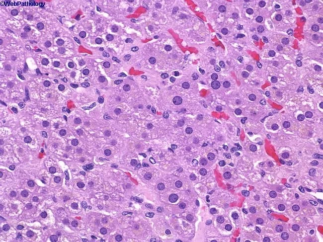 Imaging modality: Light microscopy of adrenal gland tissue, Hematoxylin and Eosin (H&E) stained section, viewed under brightfield illumination at high magnification (approximately 400x). Anatomical location: adrenal cortex with zona reticularis occupying the deepest corticoid layer, immediately superficial to the adrenal medulla, behind zona fasciculata. Visual features: cells arranged in anastomosing cords and small nests; cytoplasm is acidophilic and granular; nuclei are round to vesicular with prominent punctate nucleoli; capillary sinusoids are intermixed, producing a lobular vascular network. The zona reticularis lies between the zona fasciculata and the medulla, forming a reticular, fine meshwork. The cellular morphology indicates steroidogenic chromaffin-adjacent cells with robust endoplasmic reticulum and lipid-poor cytoplasm relative to fasciculata. Notable features include tight cell-to-cell contacts, vascularized stroma, and delineation from the surrounding zones. Pathophysiology/diagnostic significance: Normal zonation of the adrenal cortex is demonstrated; zona reticularis is responsible for glucocorticoid and sex hormone synthesis (androgen precursors), contributing to the endocrine milieu. Clinical relevance: understanding this histology supports differential diagnosis of adrenal cortical neoplasms and endocrine disorders; potential use in educational contexts, research on steroidogenesis, and histopathology training. This image serves as a reference for adrenal cortical anatomy, steroidogenic cell morphology, and the interface with the medulla.